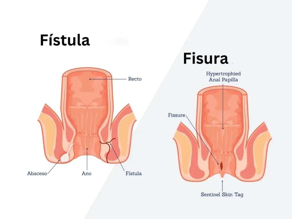 Fistula dan Fisura